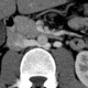 Retroaortic renal vein, duplication of renal vein: CT - Computed tomography